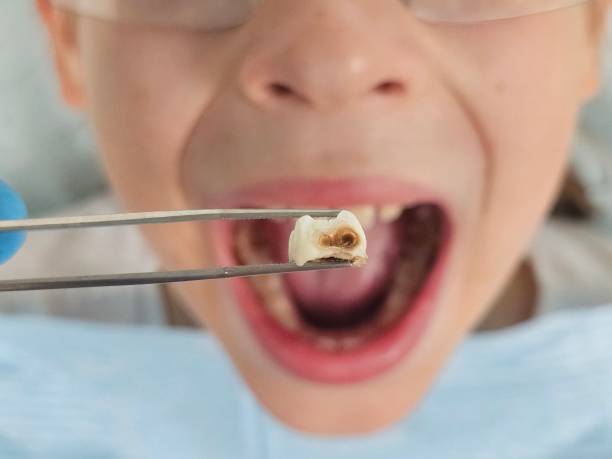 Best Emergency Dentist for Knocked-Out Tooth in Country Club Hills, MO